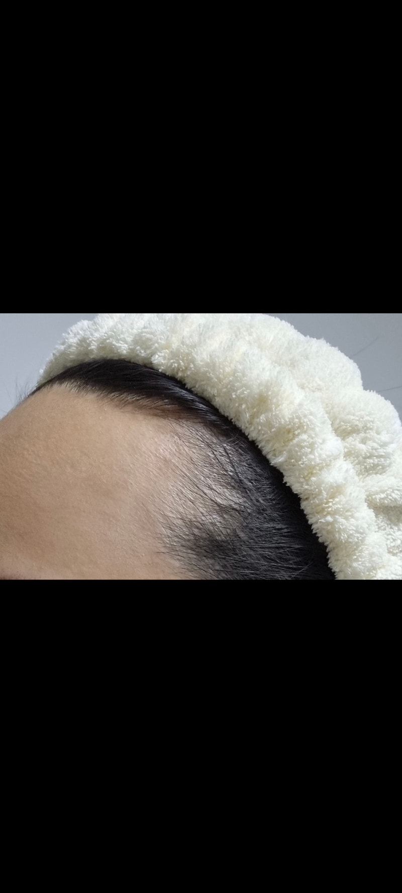 모디헤어플란트 모발이식 9개월차 후기