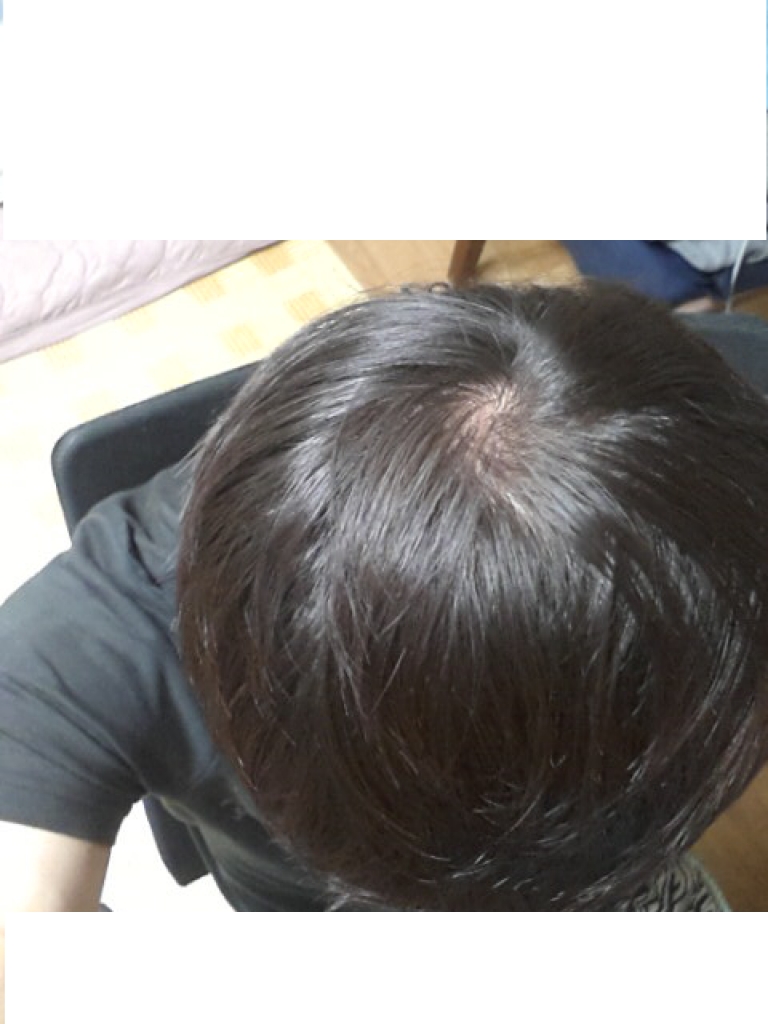 이식후 사진4.png