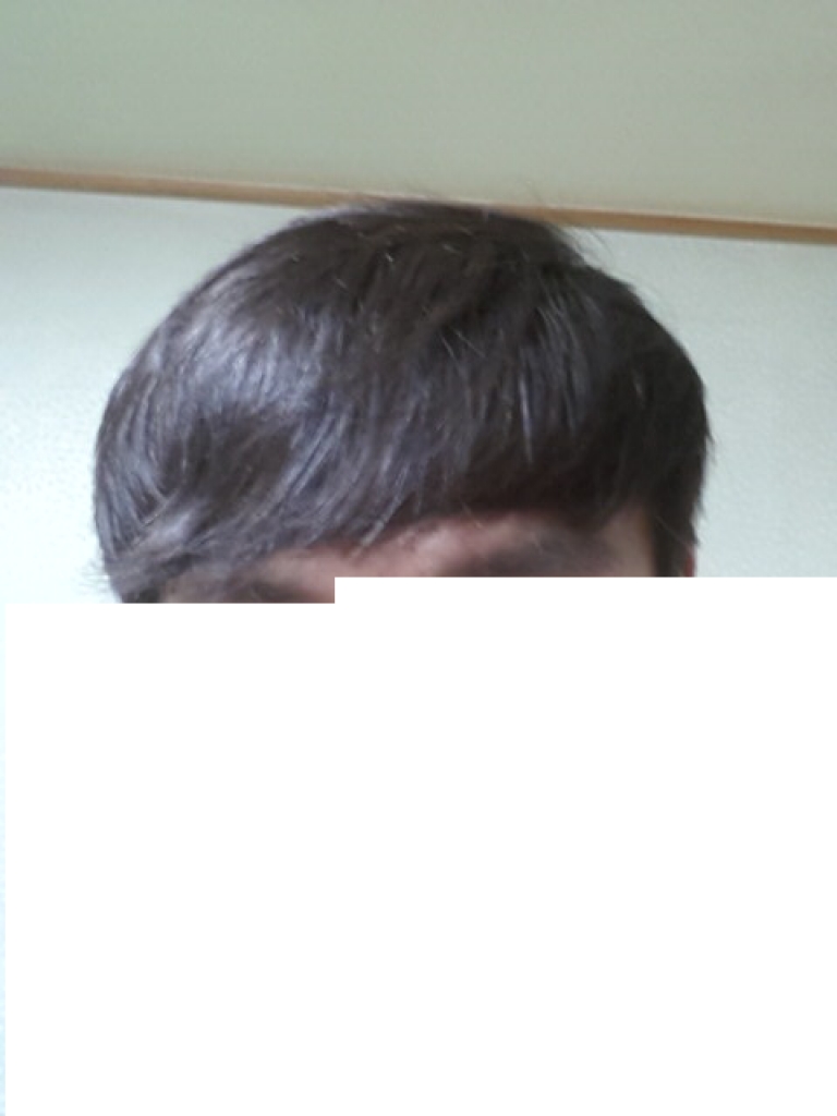 이식후 사진1.png