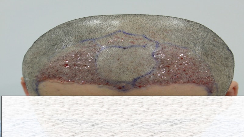 수술후 당일.jpg