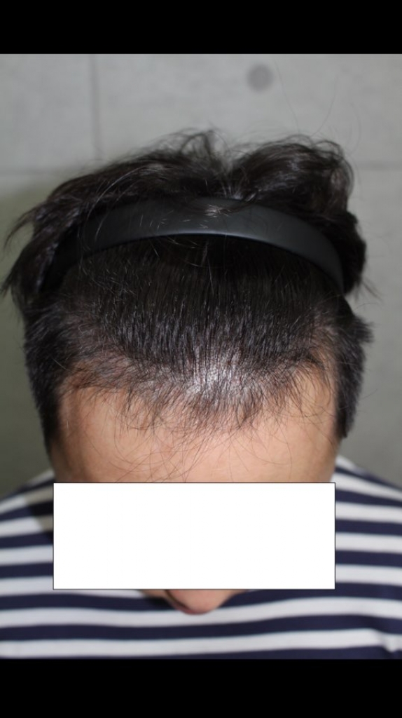 한나이브 M자 이마 헤어라인 3600모 10개월차