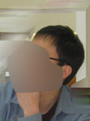 수술 후 약 7년 경과 2.jpg