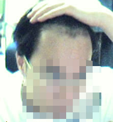 수술 후 1년 1.jpg