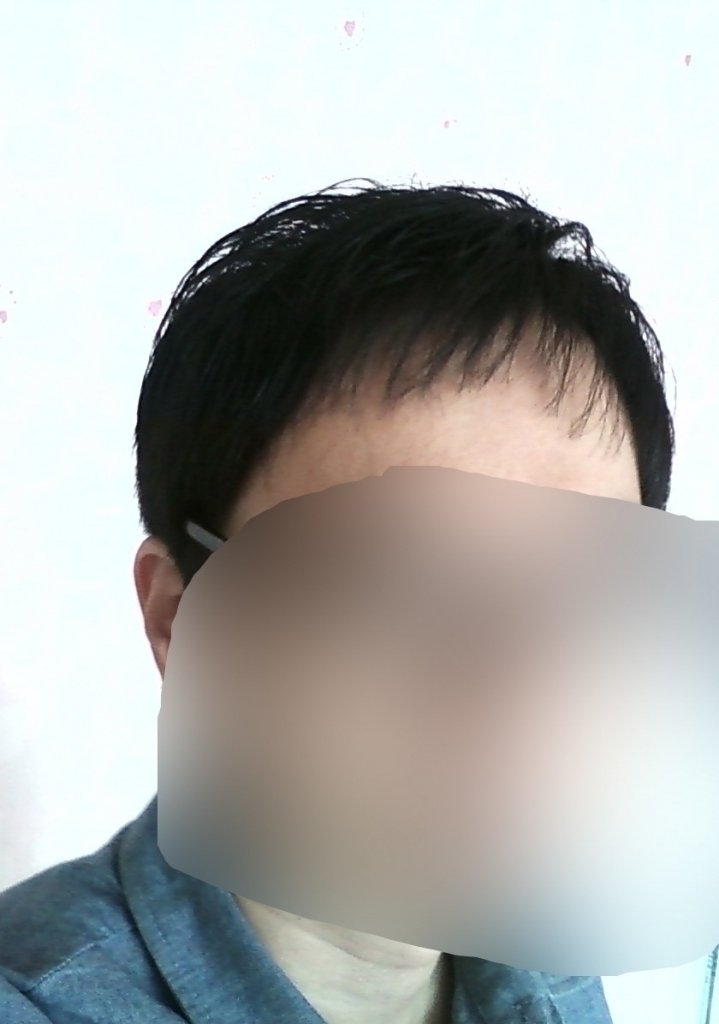 수술 후 약 7년 경과 1.jpg