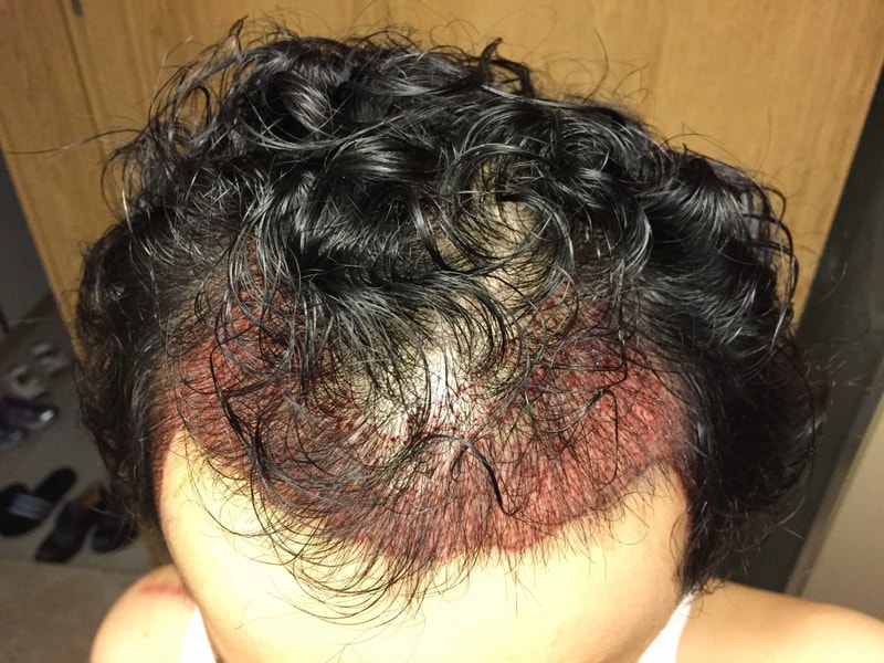 이브 모발이식센터 절개5492모 첫째날!