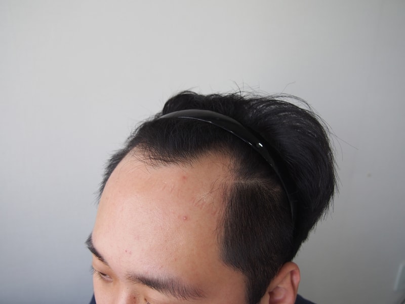 수술전 우측.JPG
