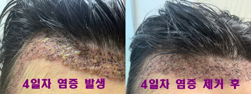 염증 제거 사진.jpg