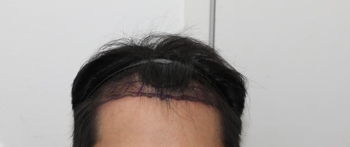 [뉴헤어]비절개 모발이식 1600모낭 3일차 후기