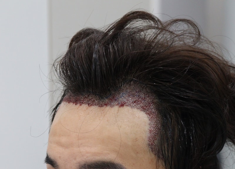 수술후 좌.jpg