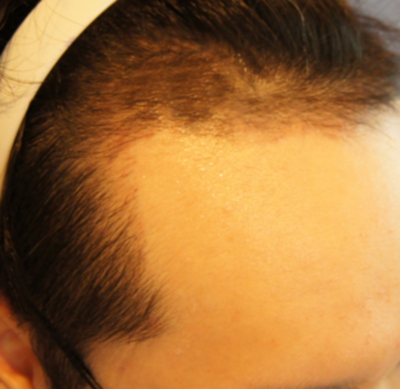 She's five months after a non-excision 1600 hair follicle transplant