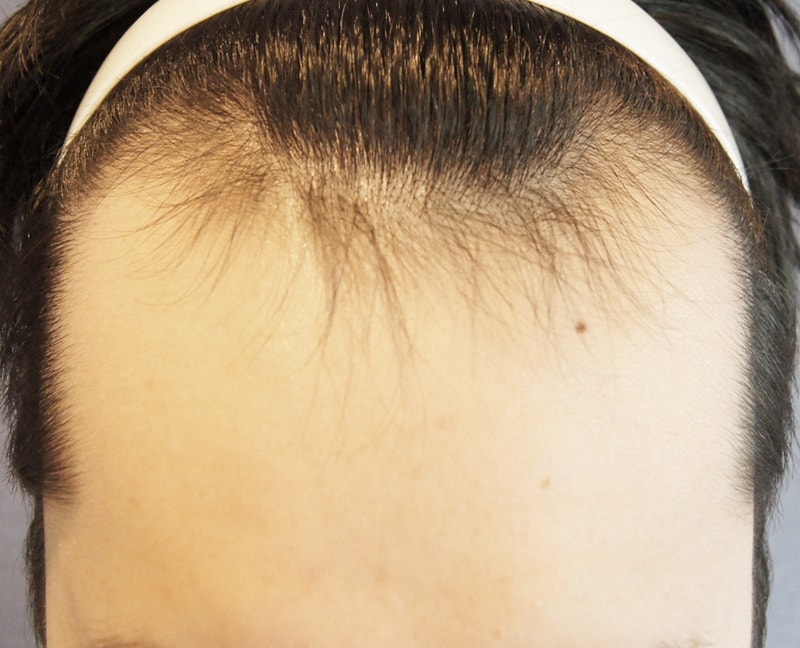 It's four months after the non-excision 1600 follicle transplant