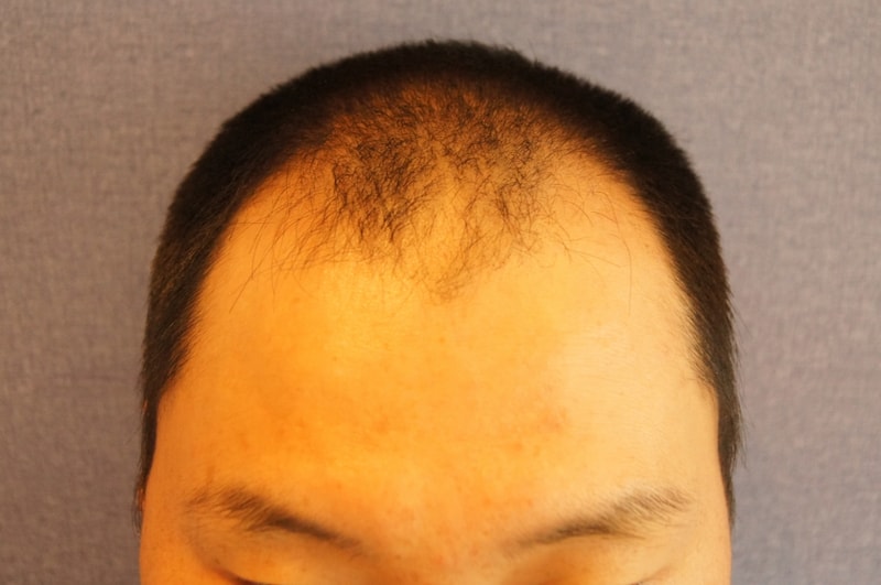 1200모낭 10개월 경과