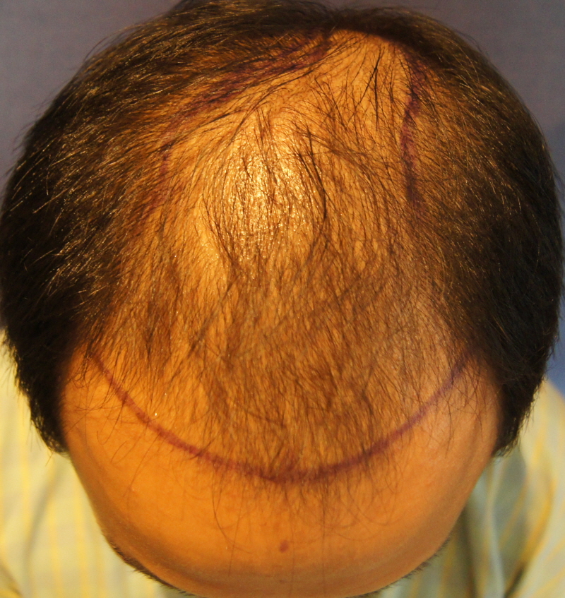 Motion 3000 follicle transplantation 2 years and 1 month survival review