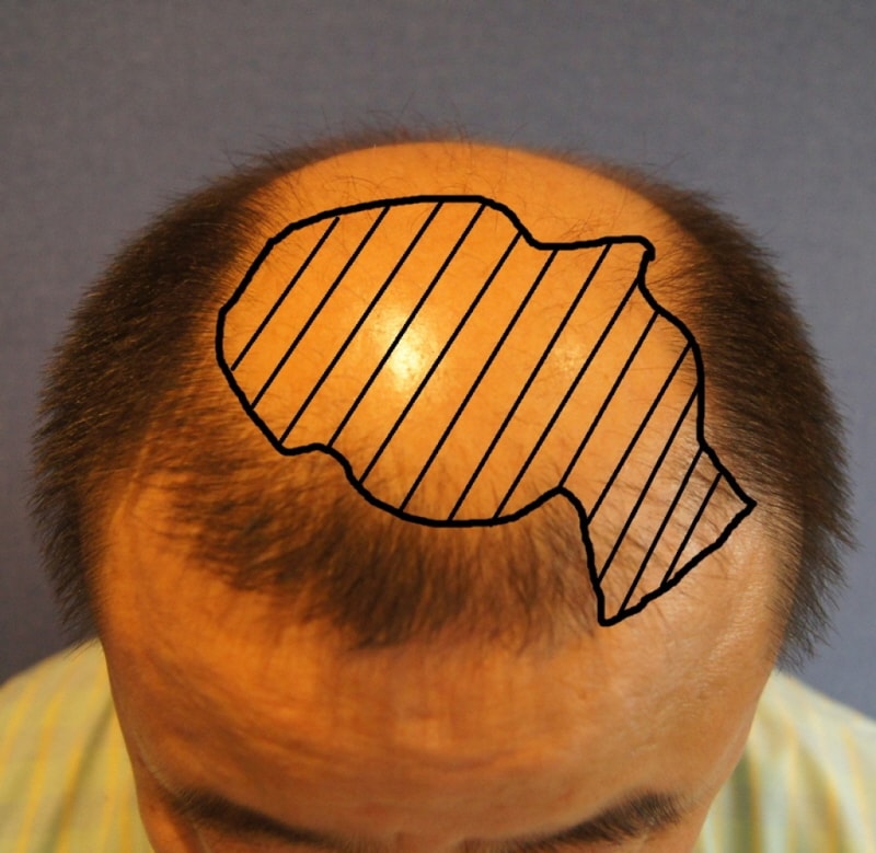 It's been two months since the mass transplant of 2,000 hair follicles