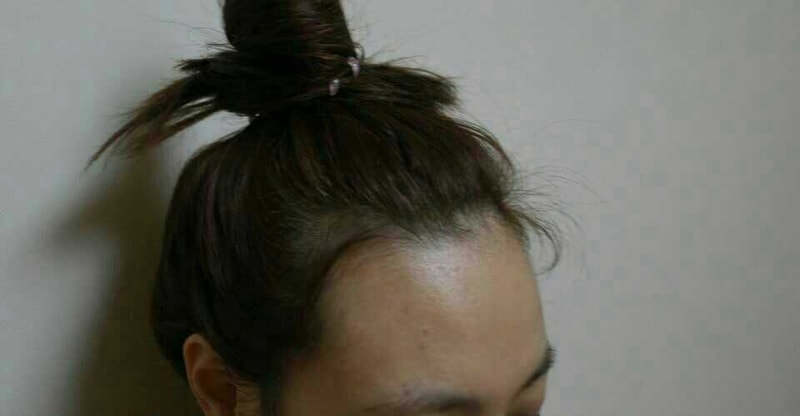 수술전 오른쪽 2.jpg