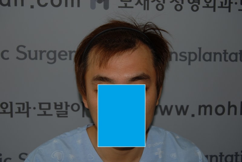 수술전1.JPG