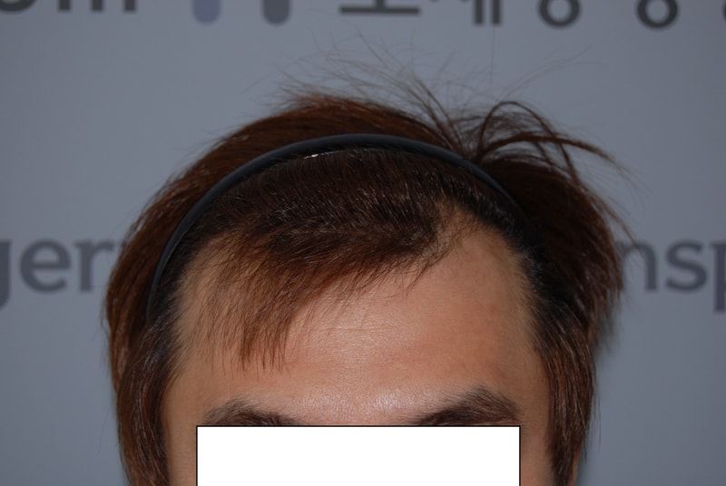 M자 2800모 절개 4개월 절반 지났네요 완전 대박 ㅋ