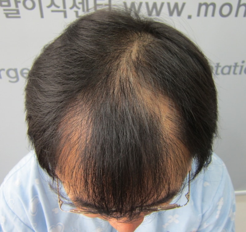 비절개 11달 모재성모발이식 2544모낭