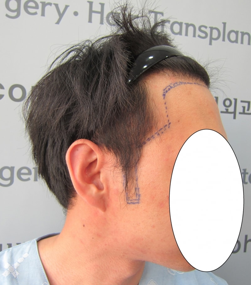 수술전1.JPG