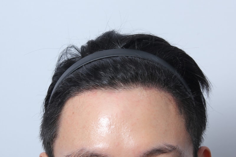 수술 후 6개월 5.JPG