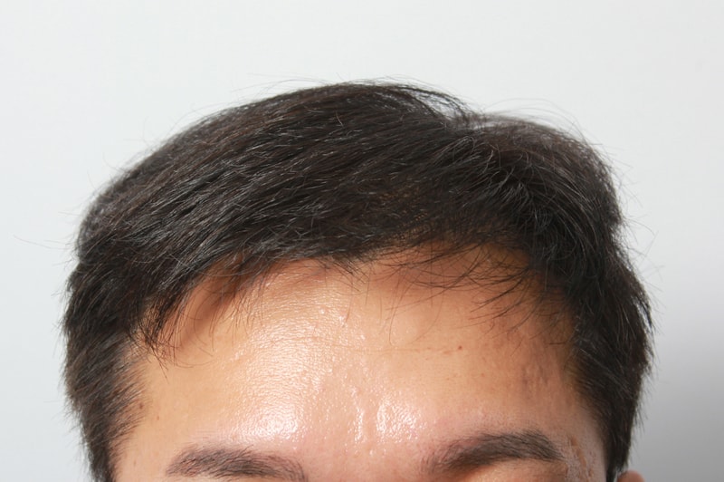 수술후 1.jpg