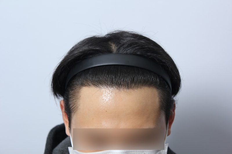 수술후 8개월 17.JPG