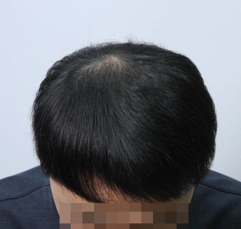 수술후 3개월 1.JPG