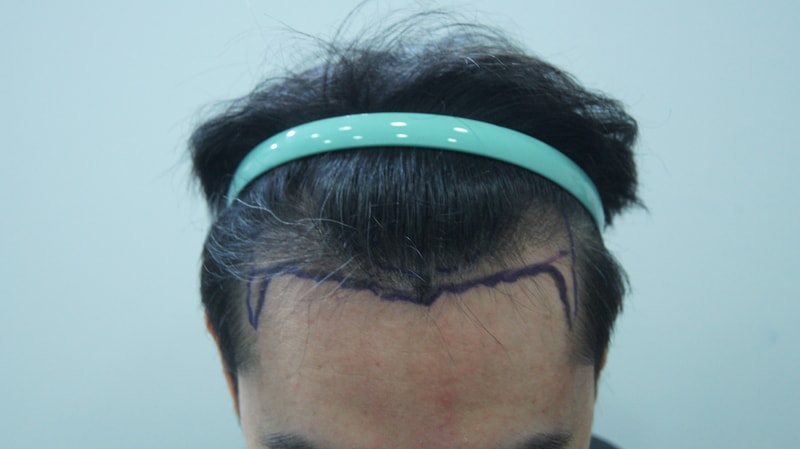 수술전 디자인.JPG