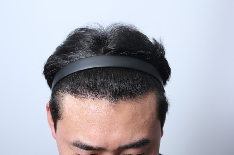 수술 후 6개월경과 입니다.