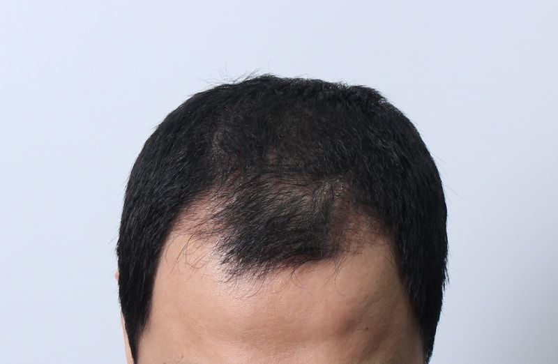 수술후 3개월 16.JPG