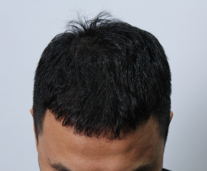 수술후 8개월 4.jpg