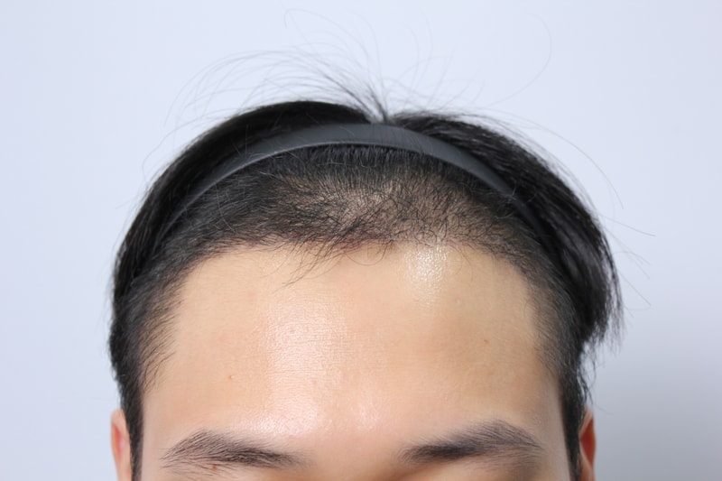 모아트 1년 1개월 최종경과