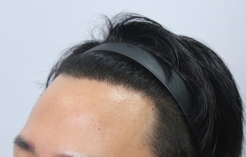 수술후 1년 37.jpg