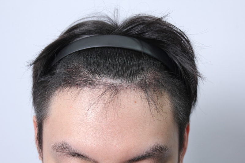 수술후 4개월.JPG