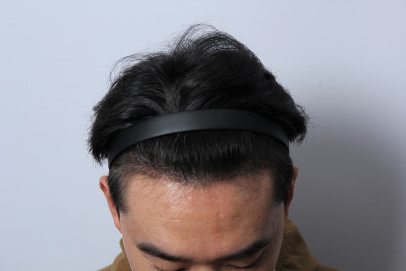 수술후 4개월.JPG