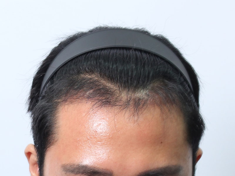 수술후 3개월 5.jpg