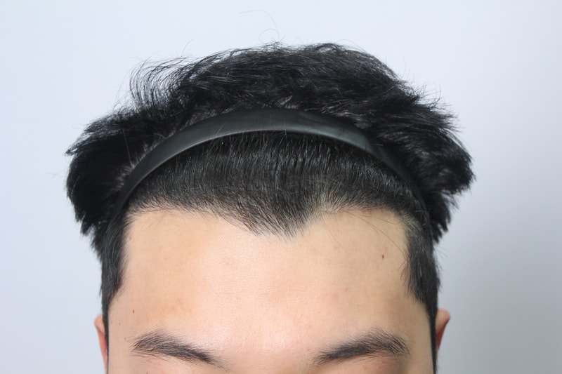 모아트 모발이식 어느덧 15개월. 시간 잘가네요