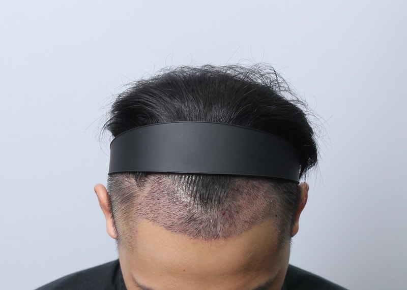 수술후3주.JPG