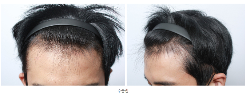 모아트의원 4개월경과 수술부터 현재까지
