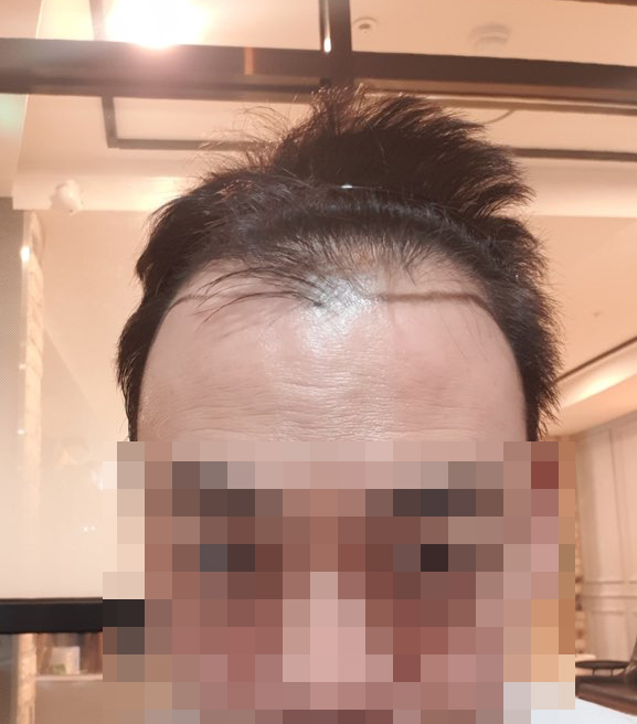 이수호 수술전 디자인.jpg
