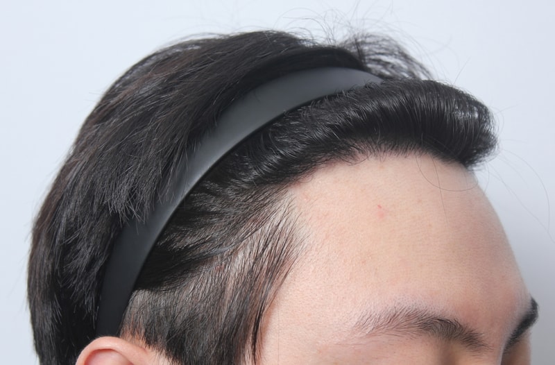 수술후 1년 36.JPG