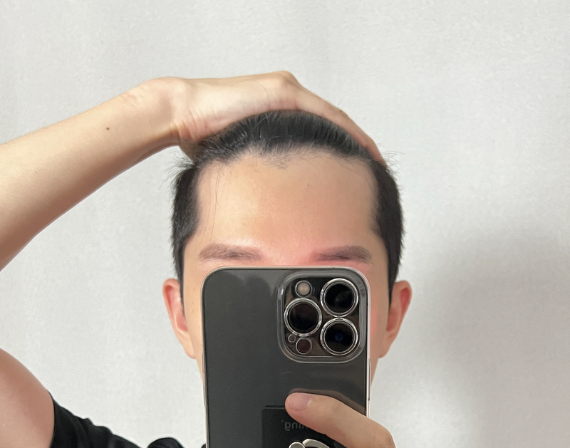 모발이식 전.png
