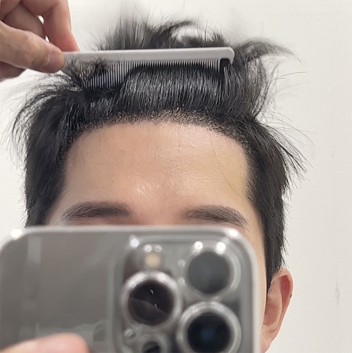 모먼트의원 무삭발 히든컷 1개월차 후기