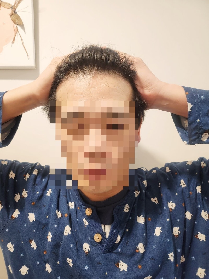 수술 후 9개월 2.jpg