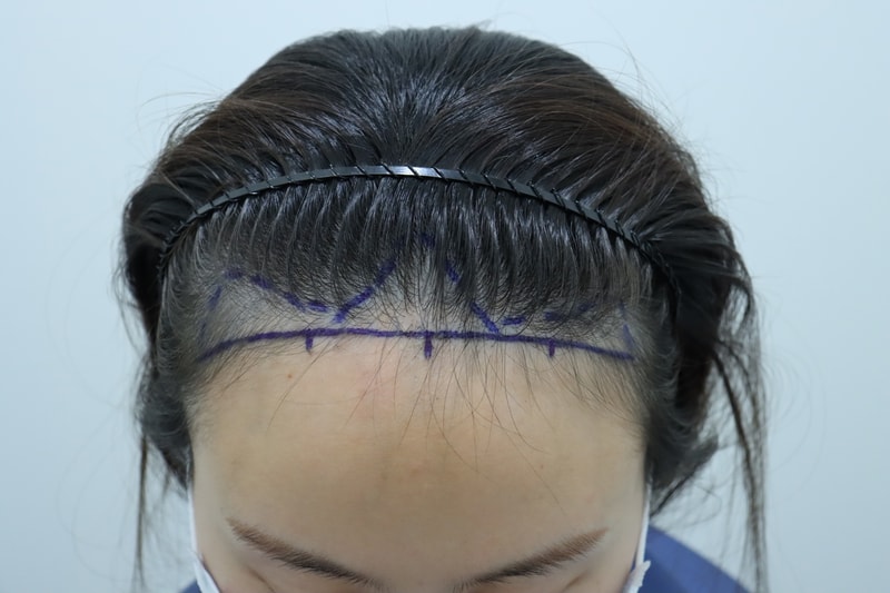 수술 전 디자인.JPG