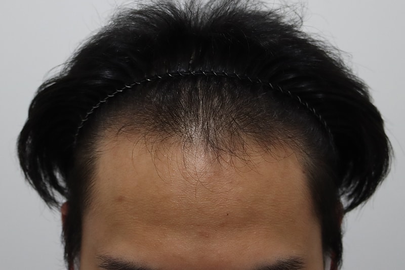 모먼트 3200모 비절개 2주 경과
