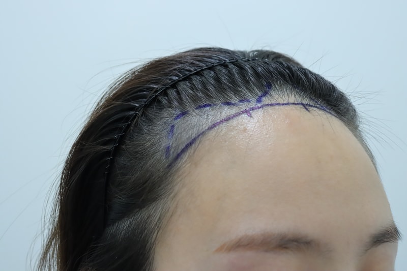 수술 전 디자인 2.JPG