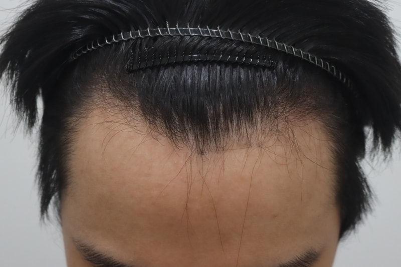 무삭발 비절개 히든컷으로 구레나룻 M자 이식 했습니다