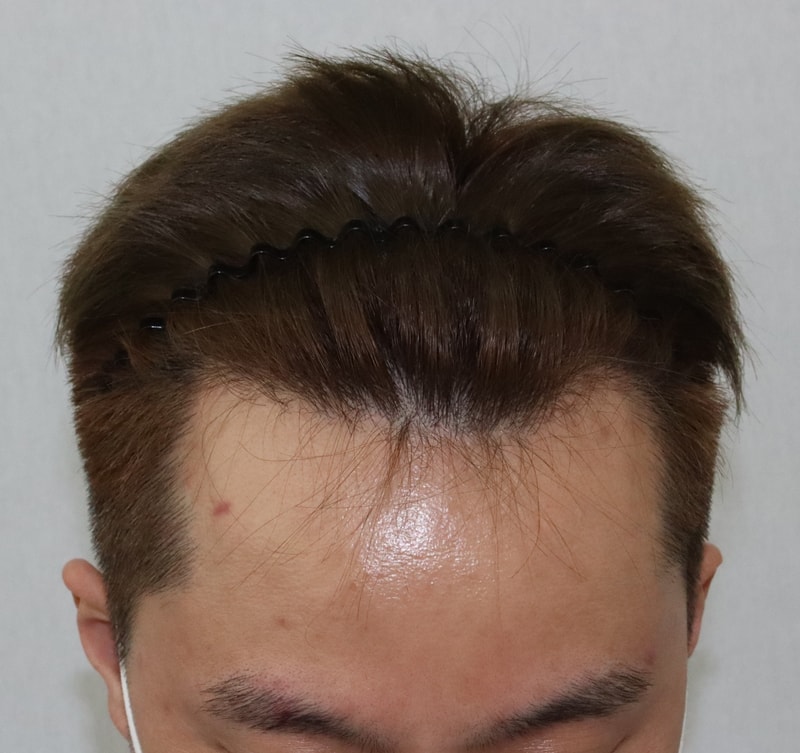 모발이식 헤어라인 1년차