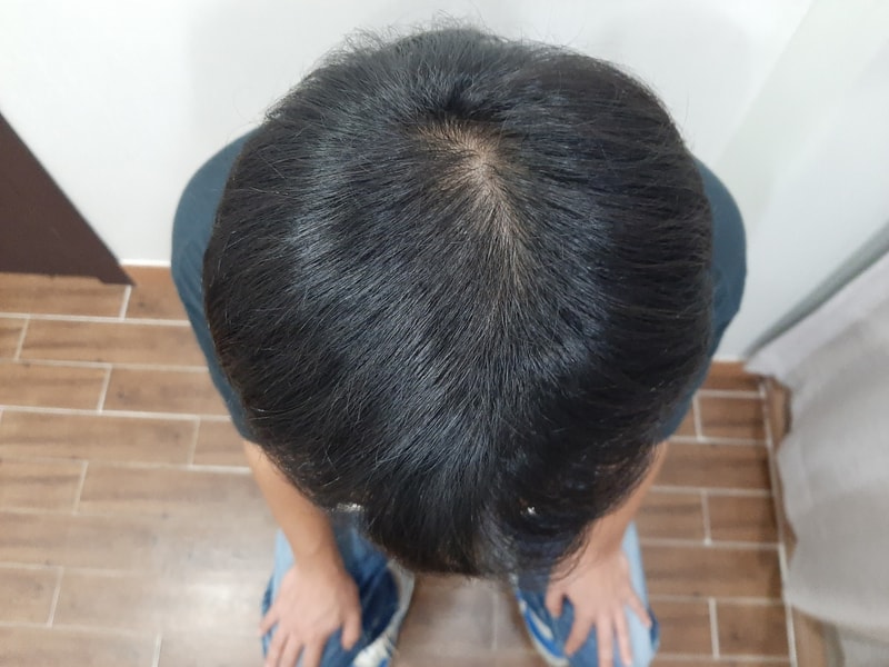 2.수술 6M2.jpg